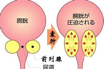 鸡西治疗前列腺囊肿的医院